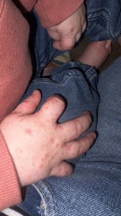 Chicken pox? (Pics attached)