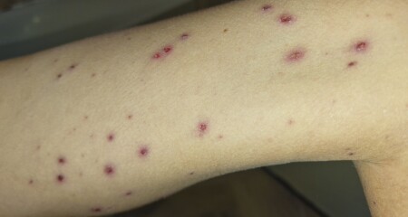 Infected chickenpox