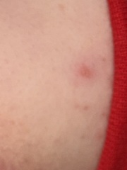 Possible Chickenpox’s