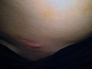Help strange stretch mark bump underneath