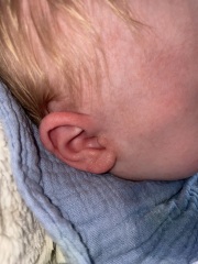 Newborn rash eczema or baby acne?