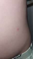 Chicken Pox or Not?