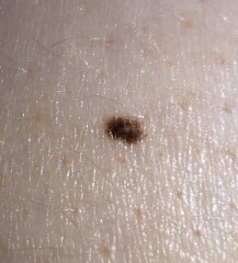 Help me to cope with the wait - a very bad feeling about a mole