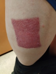 Daughter in hospital - full thickness burns