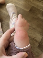 Hives for dairy allergy or something else?