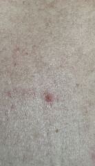 Mole - normal or get checked?