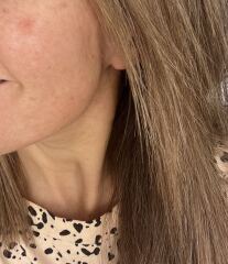Has anyone had similar on their face. Is it skin cancer?