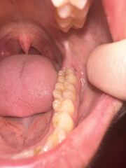 Horrible pic sorry teeth related