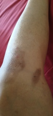 2nd degree burns from boiling water