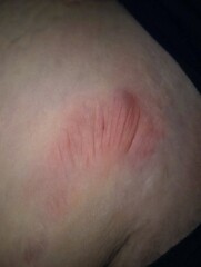 Help strange stretch mark bump underneath