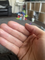 Severe Eczema Teenager