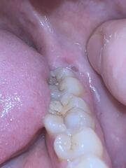 Horrible pic sorry teeth related
