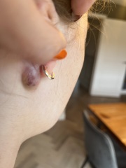 Lumps behind ears