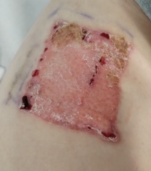 Daughter in hospital - full thickness burns