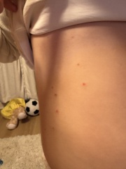 Is this chicken pox?!