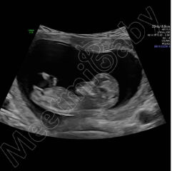 Nub and skull theory guesses - 12W 1 day