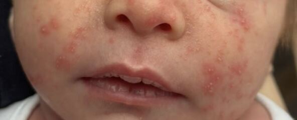 Normal newborn or CMPA?
