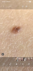 Help - Mole with dark spots - Image Included