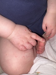 Chicken pox? (Pics attached)