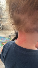 Hives for dairy allergy or something else?