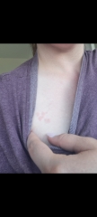 Does this look like shingles?