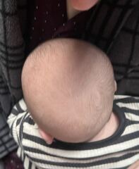 How bad is my son's plagiocephaly/flat head?