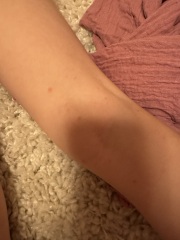 Is this chicken pox?!