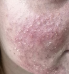 Any skin specialist here please? What is this on my child face?