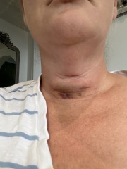 Thyroid surgery due soon
