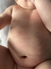 1 year old has developed red rash behind knees