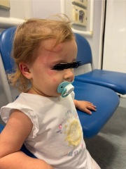 Does this look like Scarlett fever?