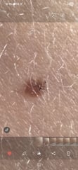 Help - Mole with dark spots - Image Included