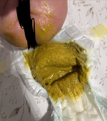 Loose/watery bowel movement - FF