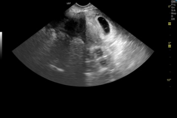 6 weeks and 5 days ultra sound scan and I’m scared it’s Blighted Ovum