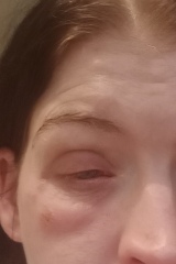 Eye problem