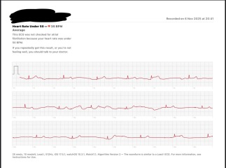 Pulse in 30s? How low is too low?