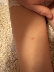 Is this chicken pox?!