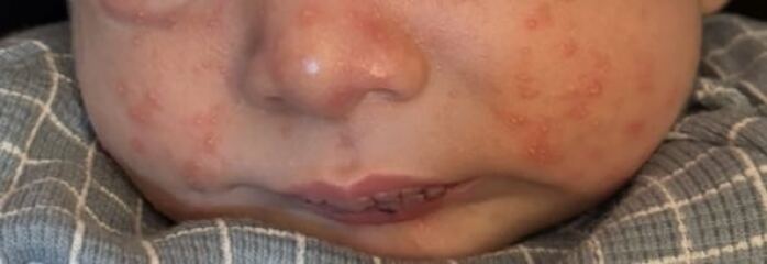 Normal newborn or CMPA?