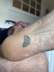 to ask for amateur dermatology help (extreme grossness warning)