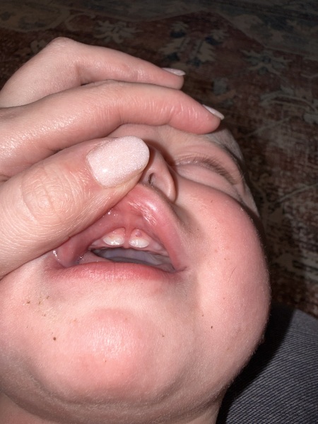 Anyone seen this weird thing on their babies teeth?