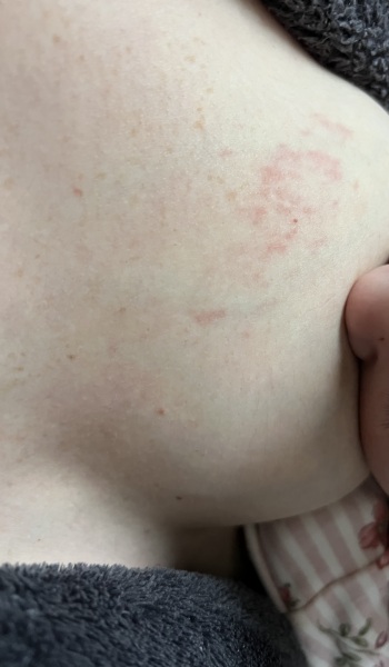 Does this rash look like the start of mastitis?