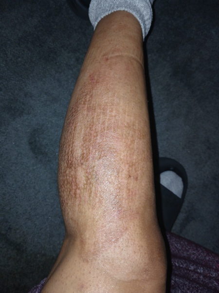 2nd degree burns from boiling water