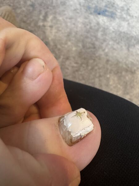 Help my toenail is coming off