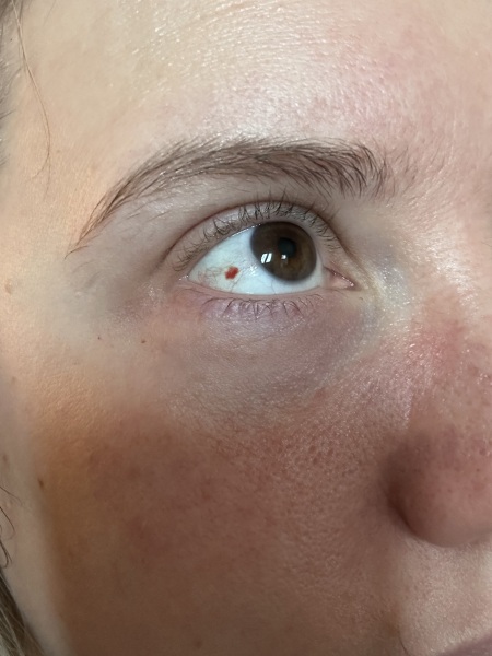 Contact lens stuck in eye on Xmas day