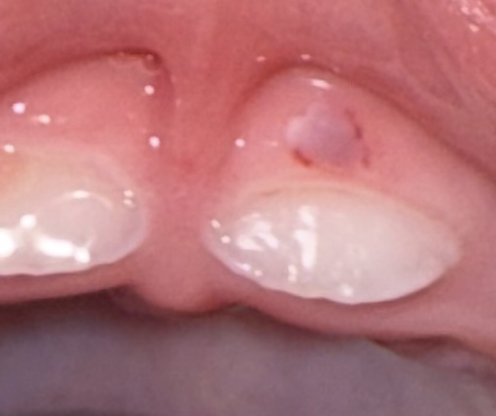 Anyone seen this weird thing on their babies teeth?