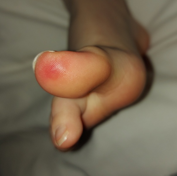 What is this on 9yo's big toe?