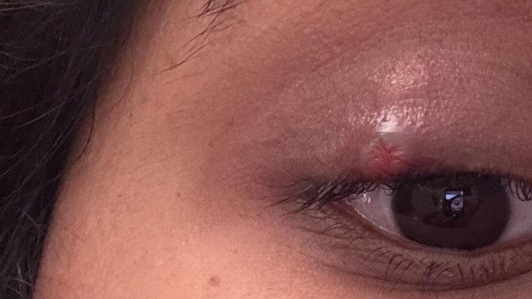 Chalazion