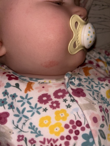 Rash on baby’s chin