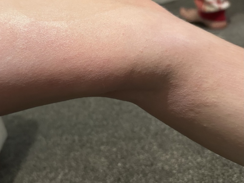 To ask people with experience if this is eczema?