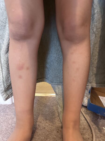 AIBU 5 year old, bruised legs